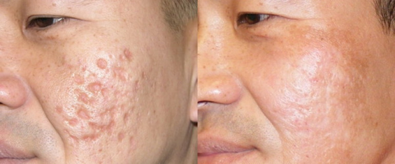 Bài thuốc trị sẹo lõm lâu năm nào cho hiệu quả cao nhất?