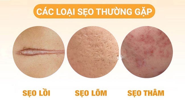 Các loại sẹo lồi thường gặp
