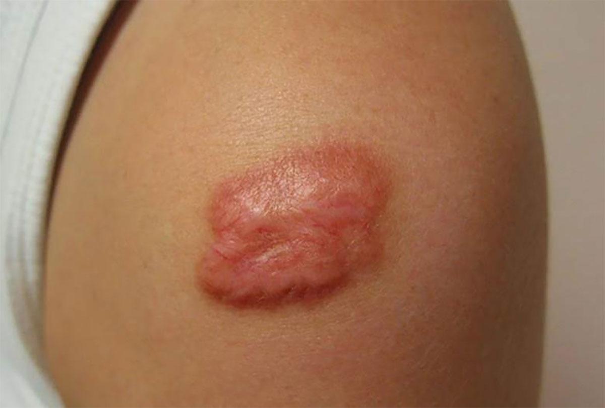 Khi nào nên cắt sẹo lồi? Khi nào nên cắt sẹo lồi?