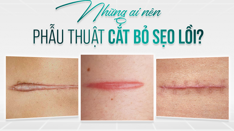 Khi nào nên cắt sẹo lồi Khi nào nên cắt sẹo lồi