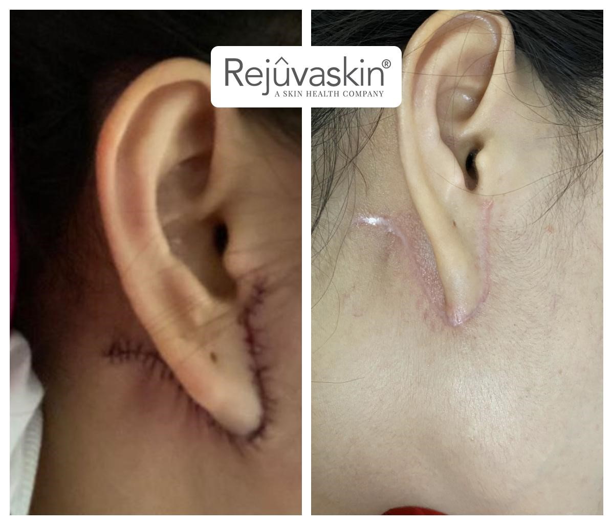 Chuyển vạt da cắt bỏ sẹo lồi Chuyển vạt da cắt bỏ sẹo lồi