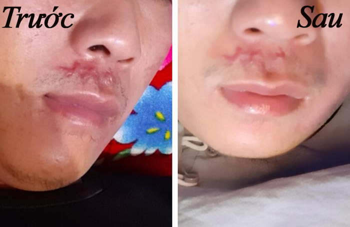 Hiệu quả sau khi sử dụng gel Rejuvasil Hiệu quả sau khi sử dụng gel Rejuvasil