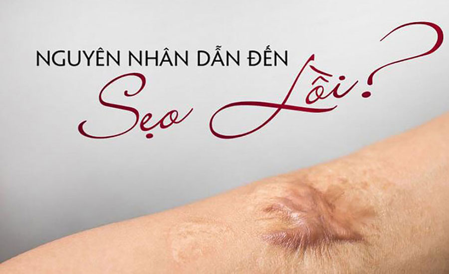 Nguyên nhân gây nên sẹo lồi Nguyên nhân gây nên sẹo lồi