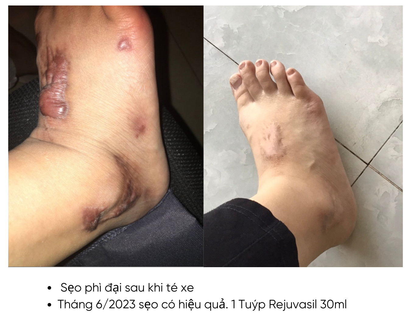 kem tri seo loi scar rejuvasil