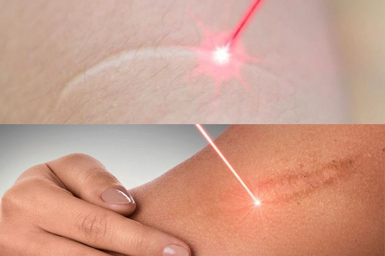 Laser sẹo lồi Laser sẹo lồi
