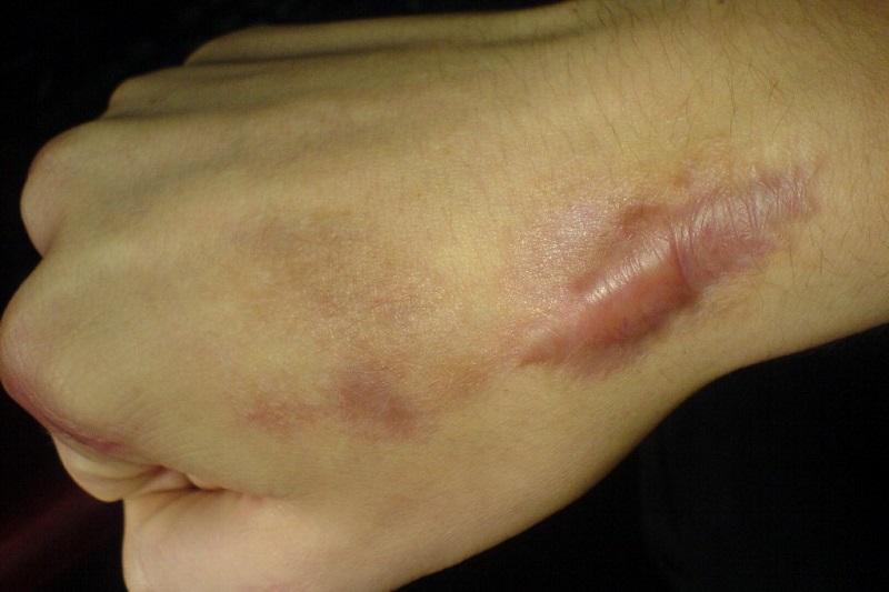 Sẹo lồi là gì? Sẹo lồi là gì?