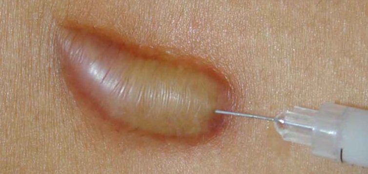 Tiêm Corticosteroid nội thương tổn Tiêm Corticosteroid nội thương tổn