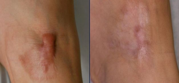 Vết sẹo lồi xẹp rõ rệt chỉ sau một thời gian sử dụng