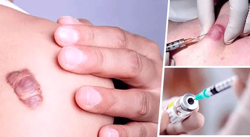 Corticosteroid đã được chứng minh là giúp làm mờ sẹo lồi thông qua nhiều cơ chế khác nhau Corticosteroid đã được chứng minh là giúp làm mờ sẹo lồi thông qua nhiều cơ chế khác nhau