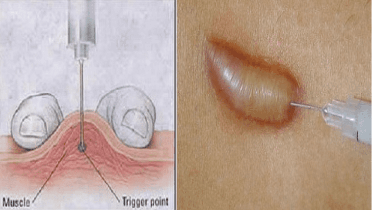 Quy trình tiêm sẹo lồi Quy trình tiêm sẹo lồi