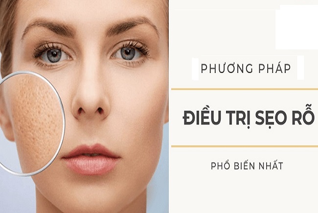 So sánh ưu nhược điểm phương pháp sẹo trị rỗ