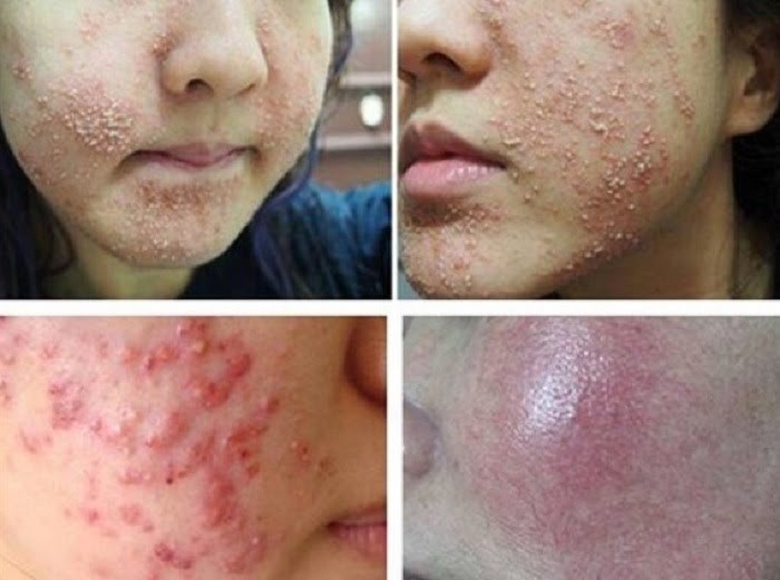 tac hai dung kem tri seo gia