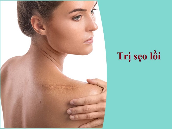 cach tri seo loi hieu qua nhat