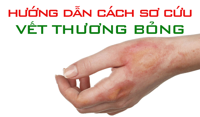 Sơ cứu vết thương bỏng so cuu vet thuong bong
