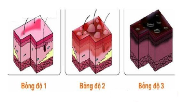 Các cấp độ bị bỏng trên da Cap do bi bong tren da