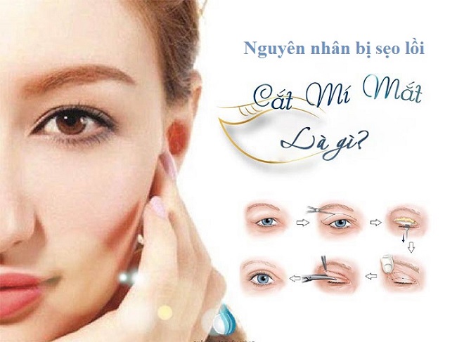 Nguyên nhân gây sẹo lồi sau cắt mí nguyen nhan gay seo loi sau cat mi