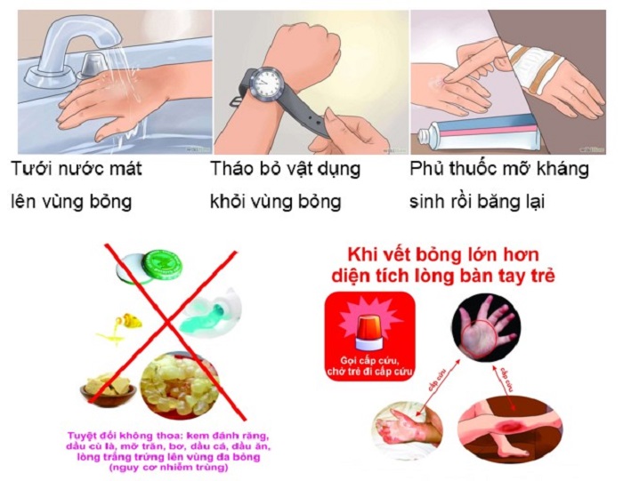 Những lưu ý nên tránh khi bi bỏng nhung dieu nen tranh khi bi bong