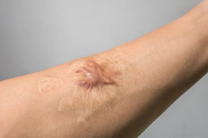 cach tri seo loi hieu qua