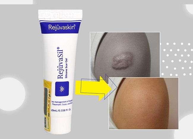 Cách làm mờ sẹo phì đại mà Gel Rejuvasil mang lại Cách làm mờ sẹo phì đại mà Gel Rejuvasil mang lại