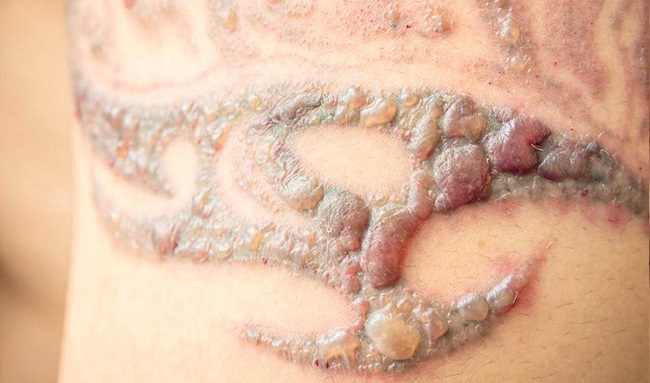 cách xóa sẹo lồi hiệu quả cách xóa sẹo lồi hiệu quả