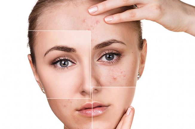 Nhiều người mắc phải tình trạng sẹo thâm kéo dài (do mụn)