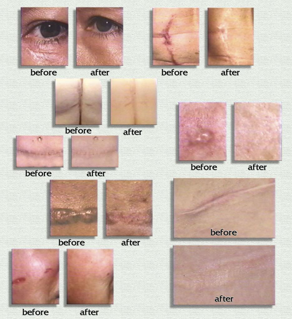 Sử dụng gel làm mờ sẹo Rejuvasil Silicone Scar hiệu quả và tiết kiệm chi phí