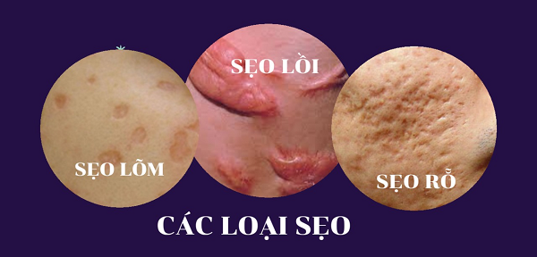 Bạn đang bị sẹo lồi, sẹo lõm hay sẹo rỗ