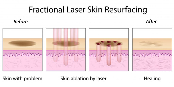 Điều làm mờ sẹo rỗ bằng công nghệ Laser CO2 Fractional