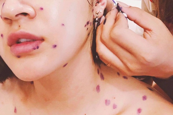 Những nốt thủy đậu là nguyên nhân chính gây nên tình trạng sẹo cho da Những nốt thủy đậu là nguyên nhân chính gây nên tình trạng sẹo cho da