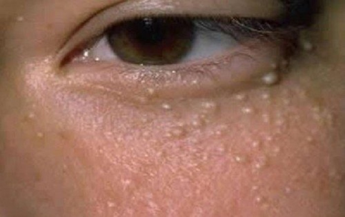 Cach tri mun thit khong de seo