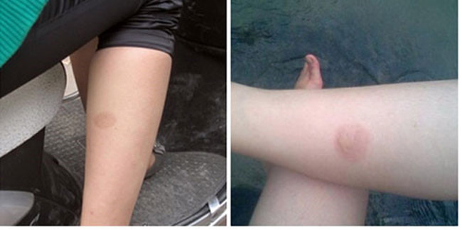 Bỏng bô thường để lại sẹo thâm và chúng rất khó để làm mờ