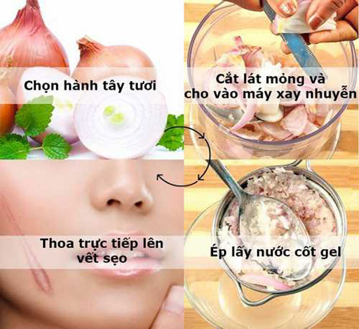 Làm mờ sẹo lồi hiệu quả bằng chiết xuất hành tây và mật ong