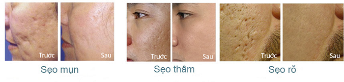 Ket qua dieu tri seo ro bang Scar Esthetique