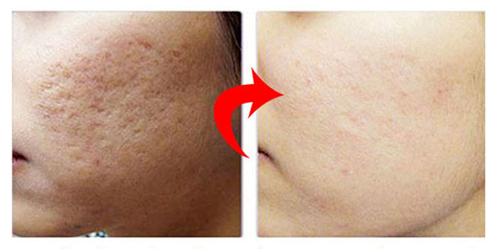 Khám phá những bí quyết giúp bạn làm mờ sẹo rỗ an toàn hiệu quả ngay tại nhà