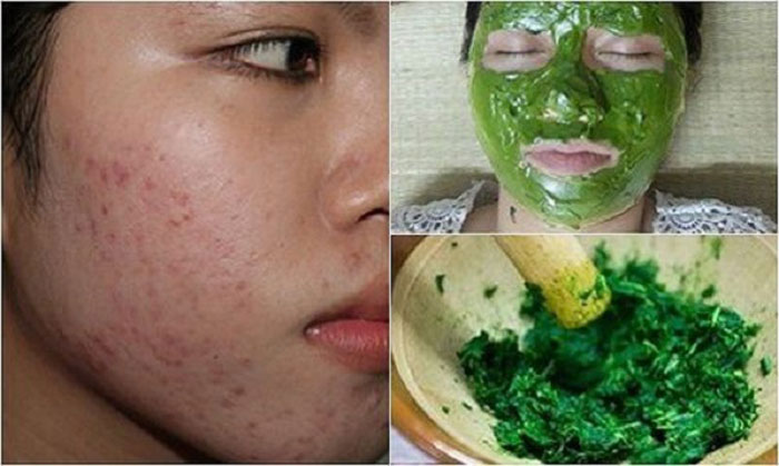 Phương pháp làm mờ sẹo rỗ tại nhà bằng rau má