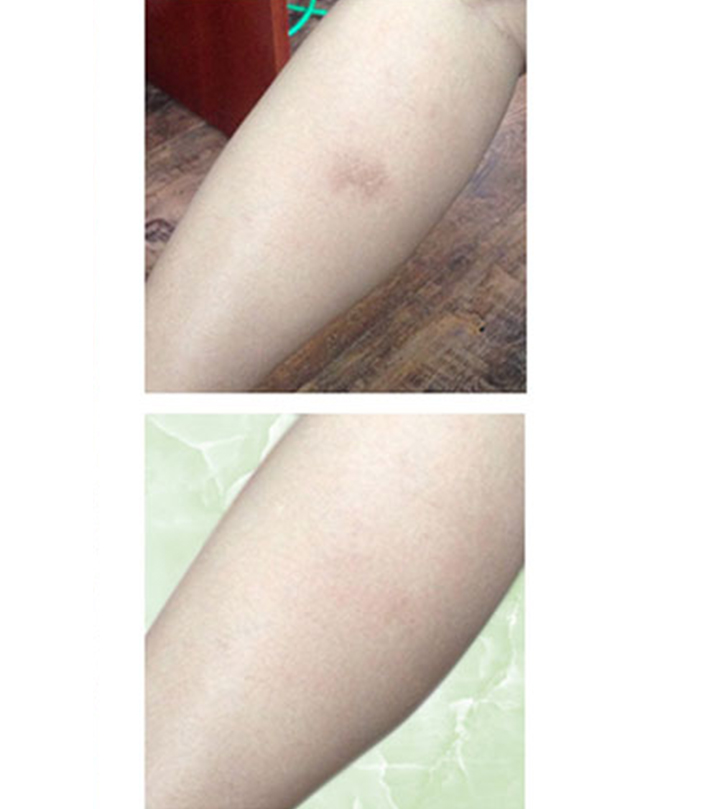 Tôi đã hoàn toàn đánh bay sẹo bỏng bô theo suốt tôi gần 2 năm qua