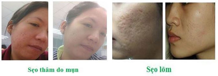 Hình ảnh của bạn Nga và bạn Minh gửi đến cám ơn Scar Heal Việt Nam vì đã giúp họ thoát khỏi nỗi ám ảnh mang tên sẹo do mụn gây nên