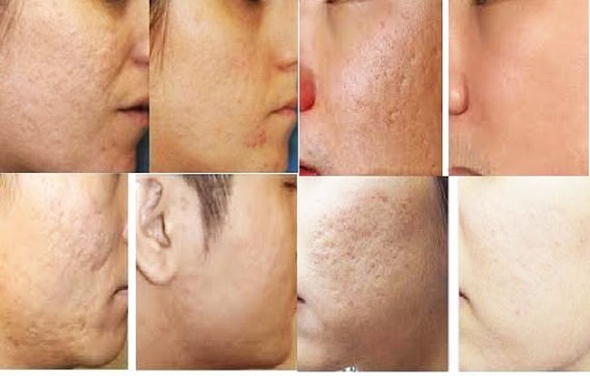 Sẹo lõm có điều trị dứt điểm được không kem tri seo lom