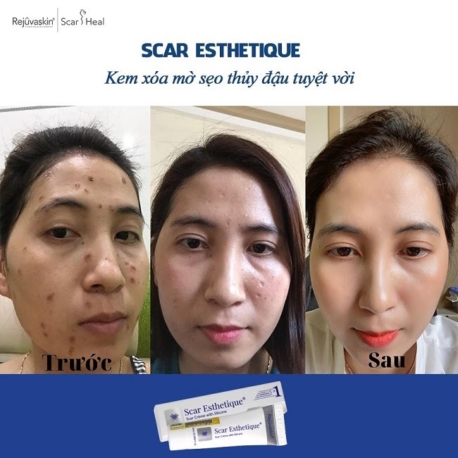 kem làm mờ sẹo lom Scar Esthetique kem tri seo lom Scar Esthetique