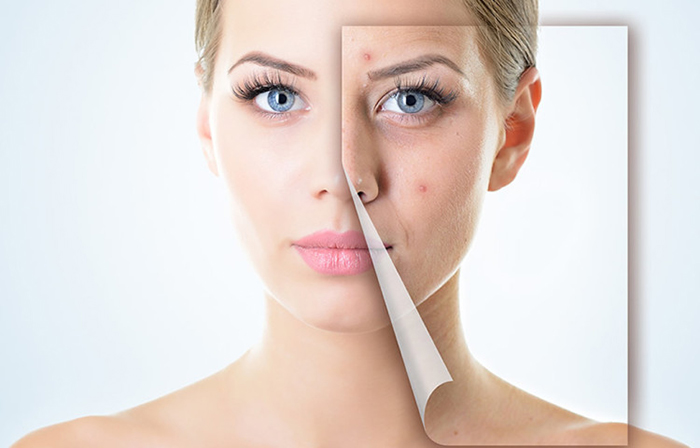 Đâu là những phương pháp làm mờ sẹo lõm hiệu quả nhất?