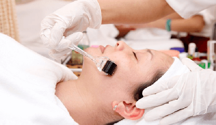 Công nghệ lăn kim làm mờ sẹo rỗ