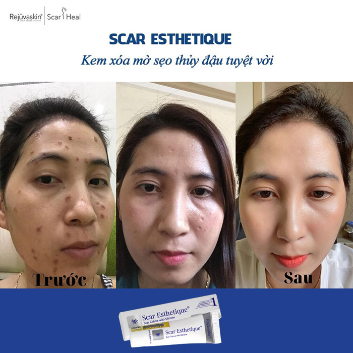 Esthetique làm mờ sẹo thủy đậu Esthetique tri seo thuy dau