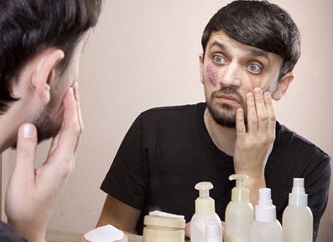 Sẹo phì đại gây mất thẩm mỹ trên gương mặt