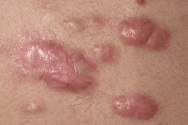 Sẹo lồi hình thành sau những vết thương phẫu thuật