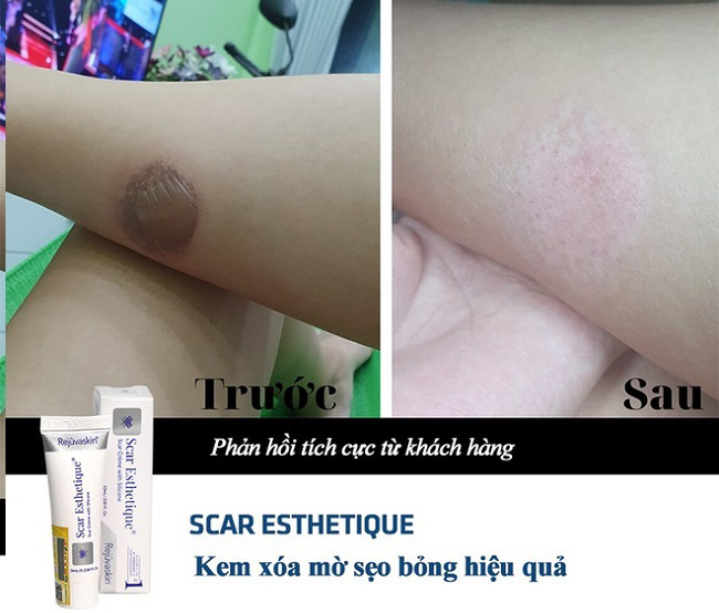 kem tri seo bong Scar Esthetique