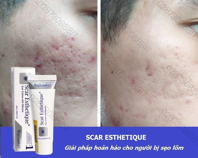 kem tri seo lom Scar Esthetique