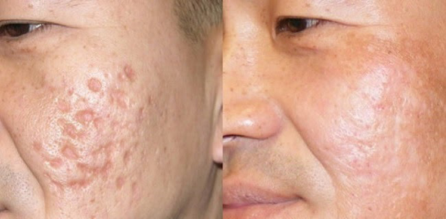 kết quả kem làm mờ sẹo Scar Esthetique