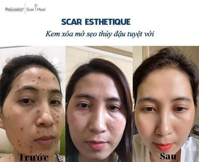 kem làm mờ sẹo Scar Esthetique ket qua dieu tri Scar Esthetuique