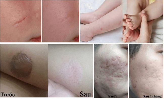 ket qua su dung Scar Esthetique