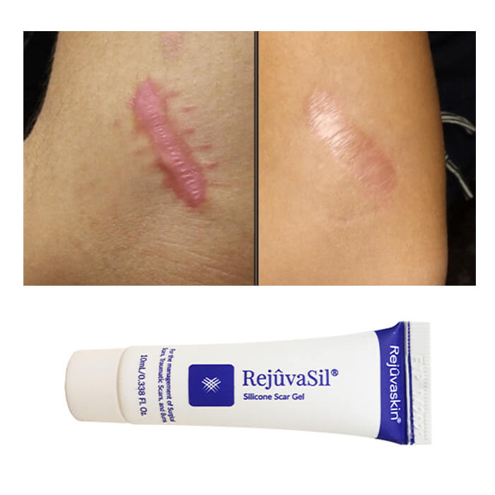 Hiệu quả làm mờ sẹo lồi kỳ diệu của Scar Rejuvail chỉ sau một thời gian sử dụng